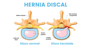 Hernia Discal, posible causa de dolor en la espalda